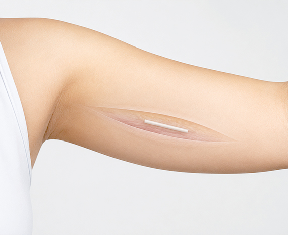 LANTE OBGYN Nexplanon Implant in Gangnam, Seoul
