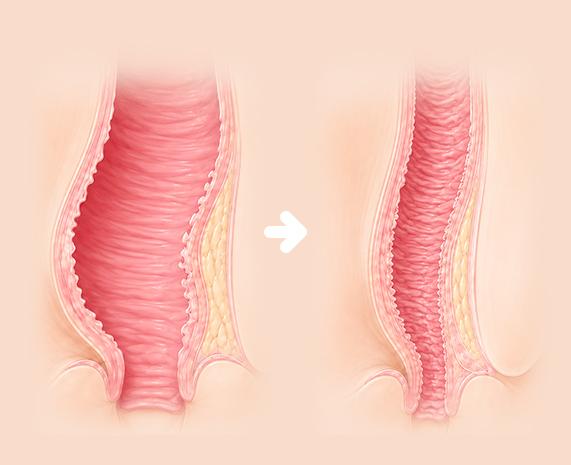 LANTE OBGYN Labia Majora Reduction & Lift Surgery in Gangnam, Seoul